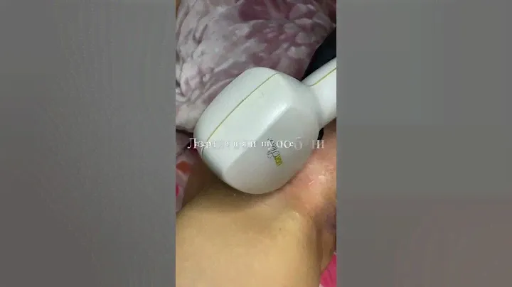 Лазерная эпиляция глубокое бикини видео