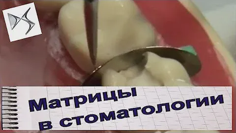 Как пользоваться матрицами при лечении кариеса  Стоматологические инструменты