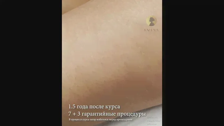 Лазерная эпиляция - 1.5 года после курс